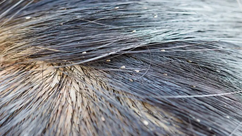 Head lice on the scalp and in hair